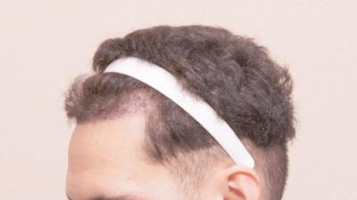 1 month after motion 1100 hair follicle non-cut hair transplant