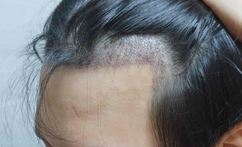 It's been a month since my hair transplant