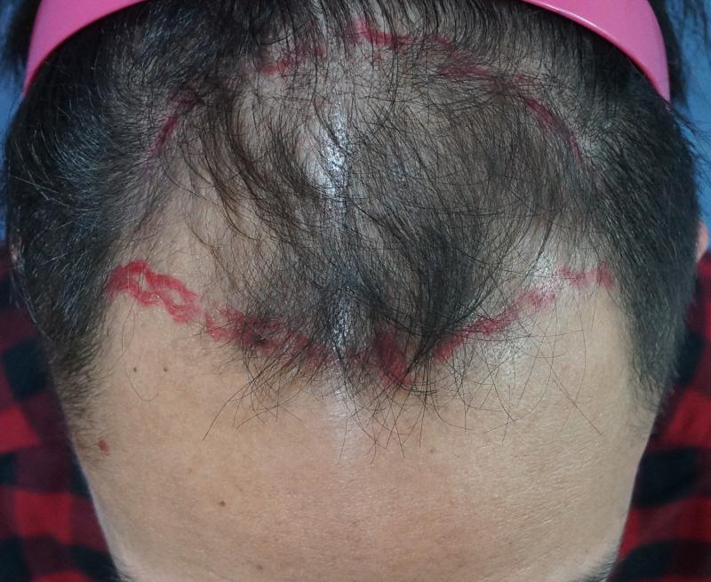 Evaluation of Motion Non-Cutting 2000 Hair Orthography