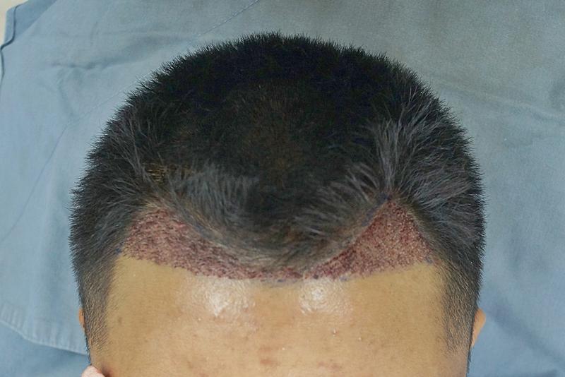 Convenience store part-time job for 3 months and hair transplant___100 days