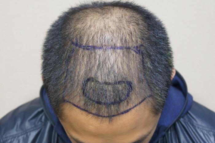 2000 Hair follicle front total density surgery 4 months ago