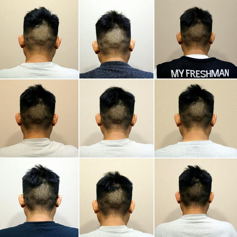 非切开1年后头部疤痕情况
