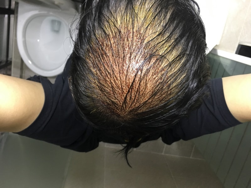 3月8日接受了毛发移植手术。 ~