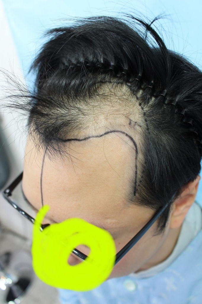 안녕하세요. 7개월차 경과 다녀오면서 포토평가도 같이 올립니다.