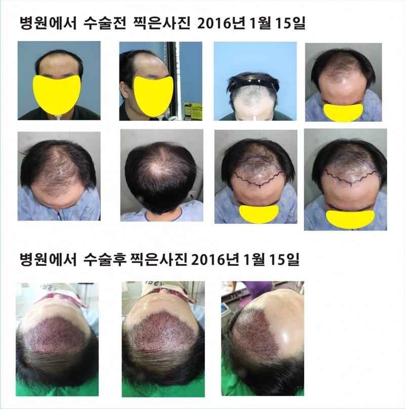 切開 非切開 混合 5120毛