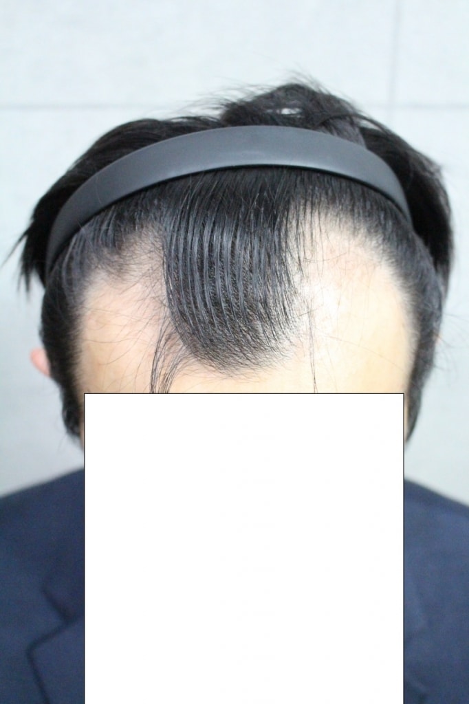 第4个月的后记！ 渐渐见效了