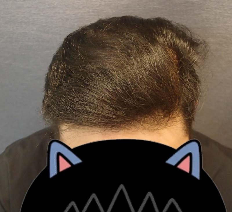 수술후1년2.jpg