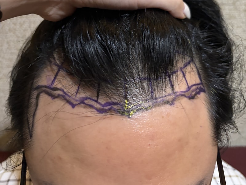 毛发移植第6天后期（非切开/3,200毛/江南毛发移植医院）