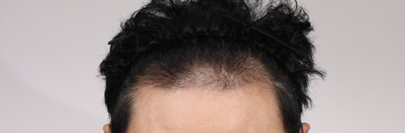 모발이식전.jpg
