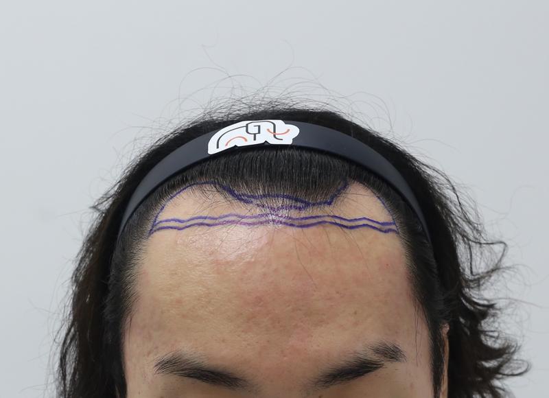 Apgujeong mammoth hairline m-shaped hair transplant in 7 months