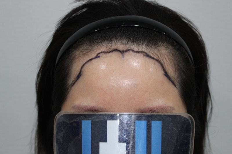 모더함 정한별 원장님_여성 헤어라인 수술당일