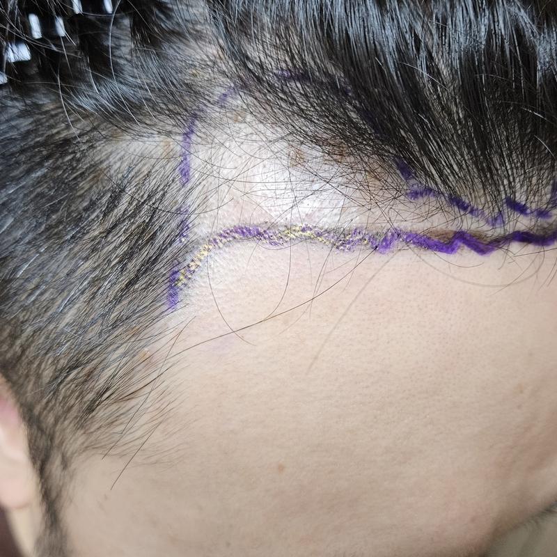 [DA Plastic Surgery] 6 Months Review of Non-Cutting No Cut
