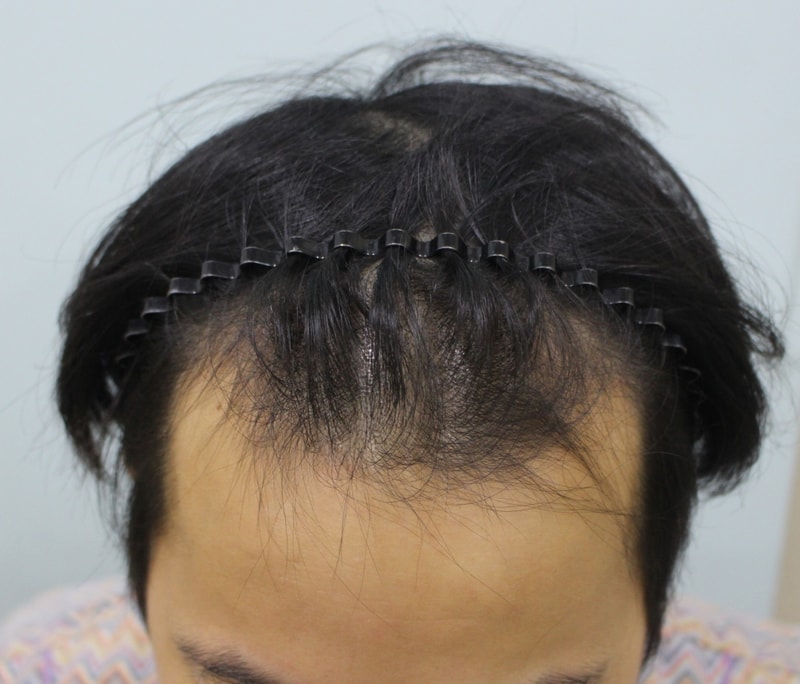 수술전.jpg