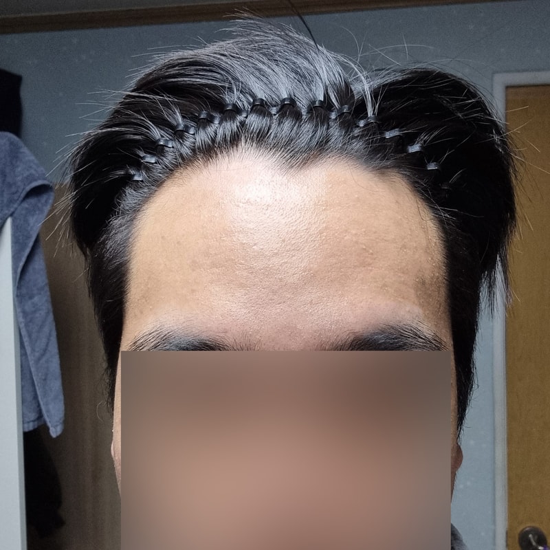 Non-cut 3000 hair transplant 2 weeks passed