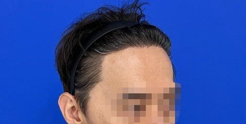 It's a review of 2500 non-cut hair implants