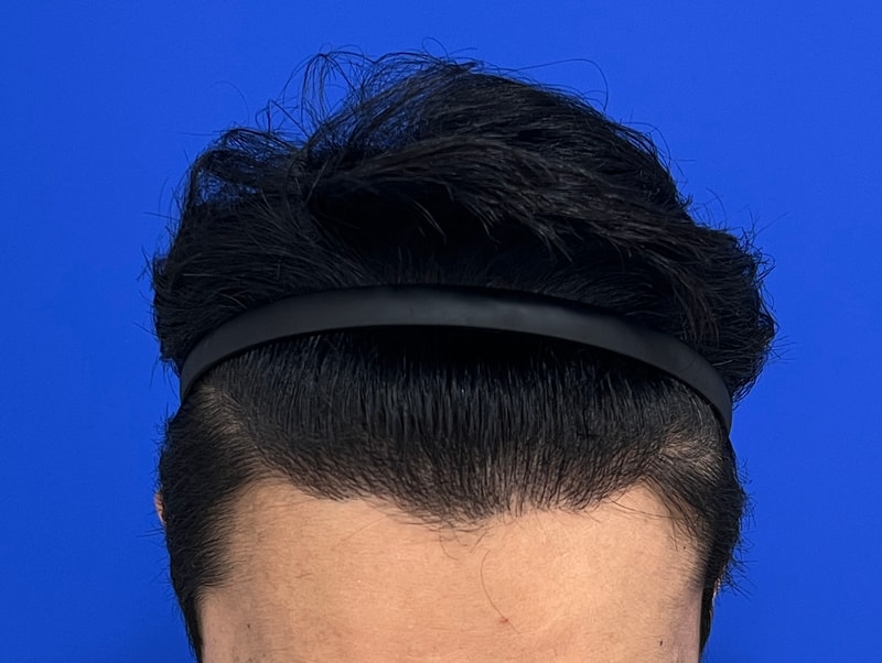 수술후12m 2.jpg