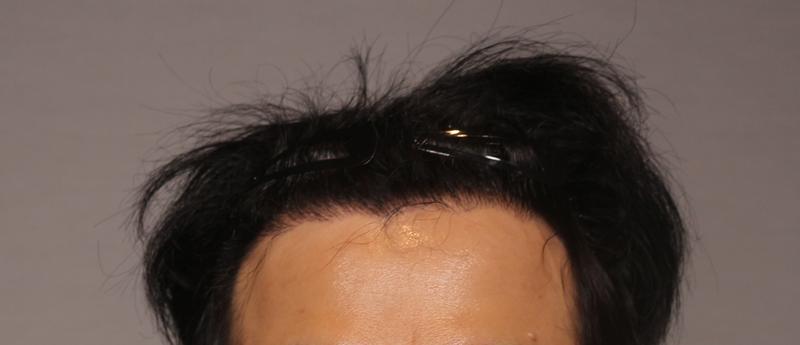 모아만의원에서 모발이식 받고 6개월차입니다
