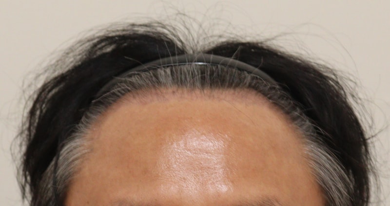 3. 수술후_3개월_1.JPG