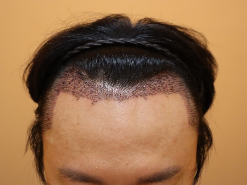 이식후3.jpg