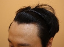 釜山ヘアロ医院3600モビ切り2週目のレビューです