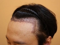 이식후1.jpg