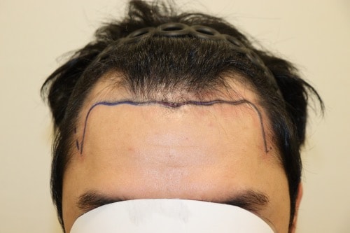 대구 헤어로 모발이식의원 비절개 3000모 2주차 경과후기