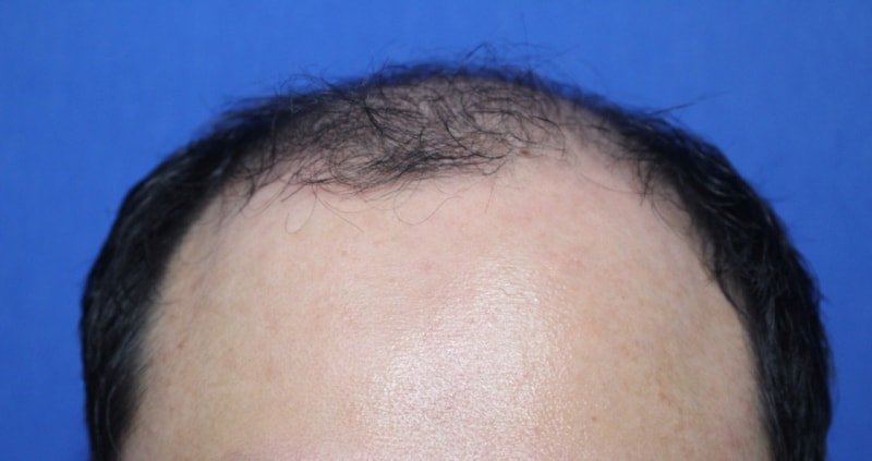 I had a 4500-movie incision.