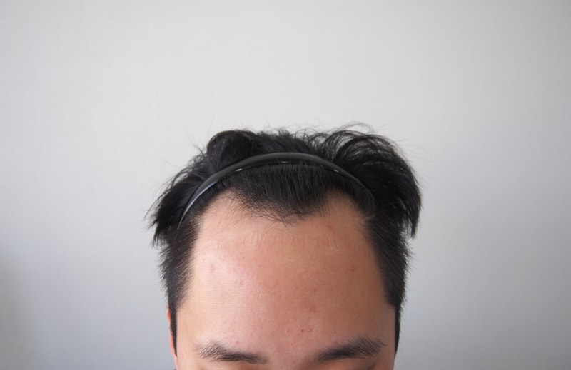 수술전 정면.JPG