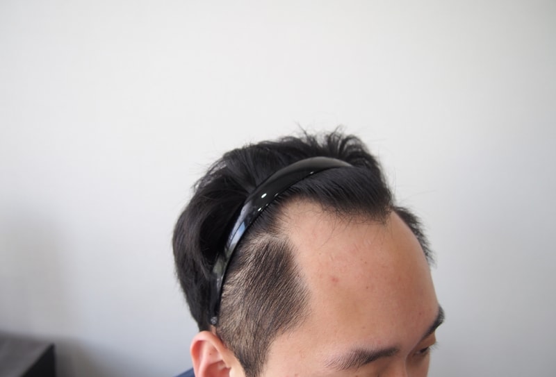 수술전 좌측.JPG