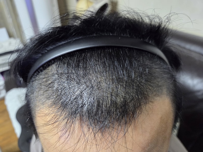 동탄 헤어로의원 2주차 경과 비절개 모발이식 4000모 수술직후