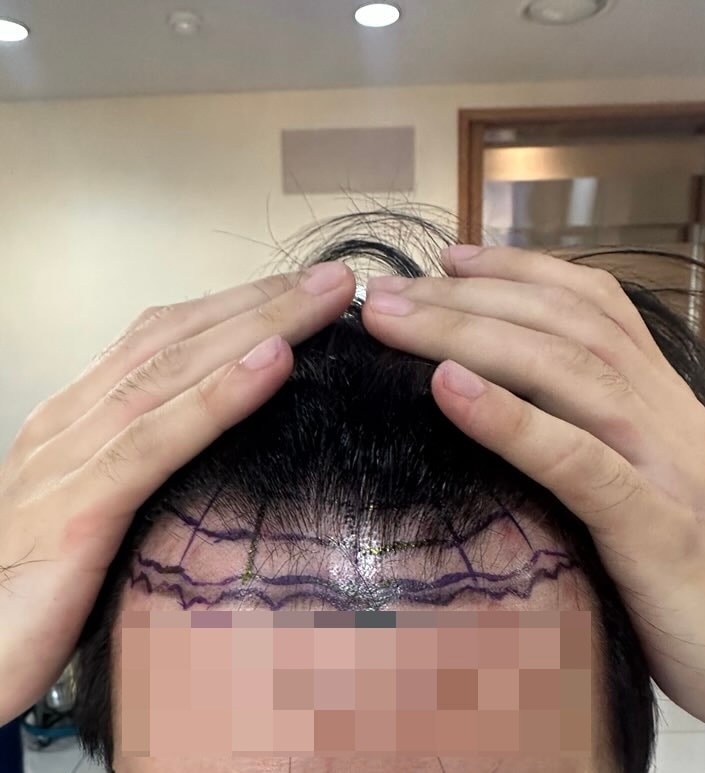 강남모발이식병원 뉴헤어성형외과 1500모낭 후기