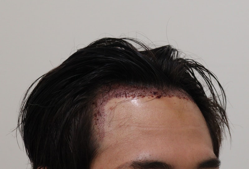 2. 수술후_1일_3.JPG