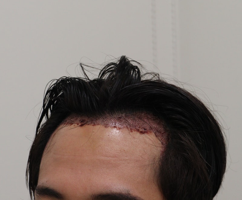 2. 수술후_1일_2.JPG