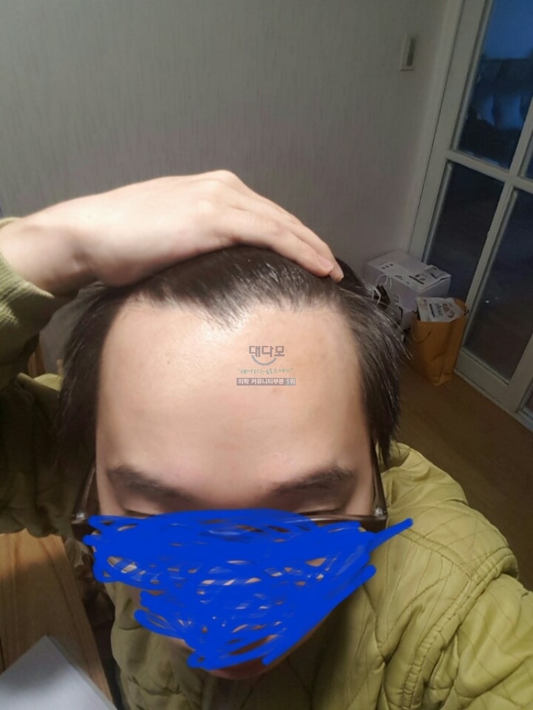 1400모낭 9개월차 후기 다들 득모하세요~!