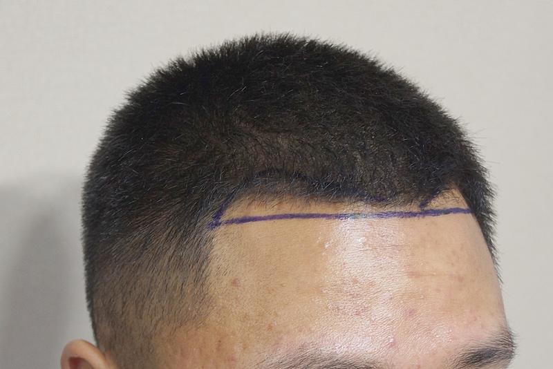 Working at a convenience store for 3 months and getting a hair transplant