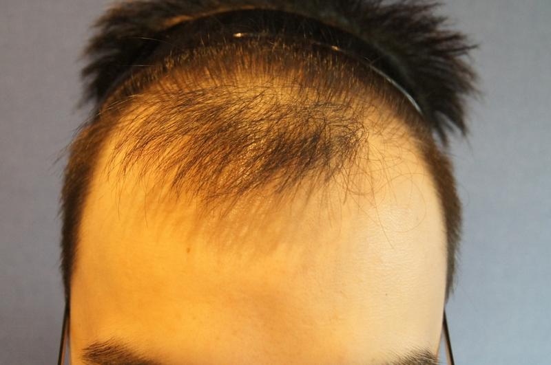Motion 1200 hair follicle incision for 8 months