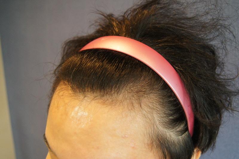 エムザ 頭頂部 1200毛包 1年 手術満期 レビュー