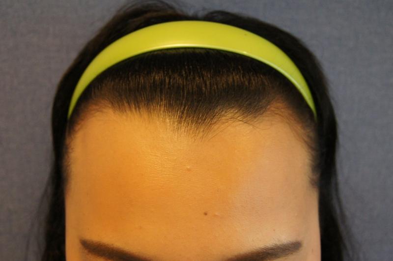 7th month of hairline implantation in Motion