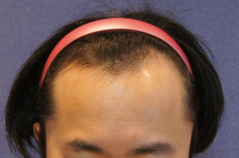 动作发际线1600毛囊维持2年6个月后记