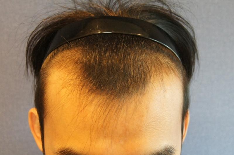 Motion 1250 1 year and 3 months after hair follicle surgery