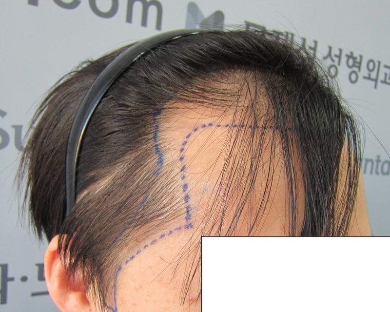 크기변환_수술전2.JPG