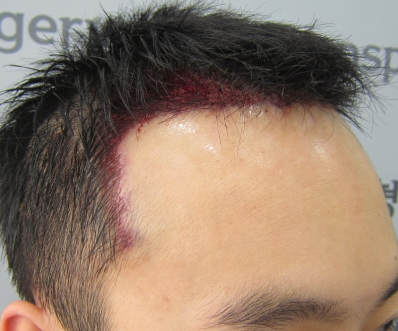 수술후1.JPG