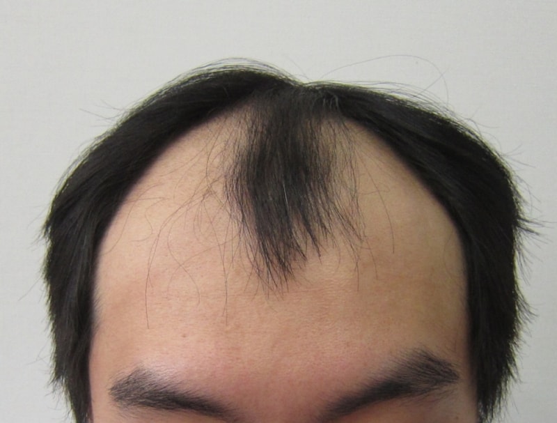 I transplanted 5,820 hair