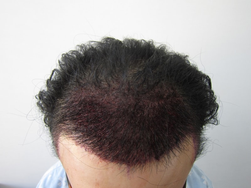 수술후1.JPG