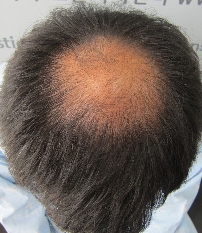 Non-cut 1910 hair transplantation with hair follicles in late 4 months