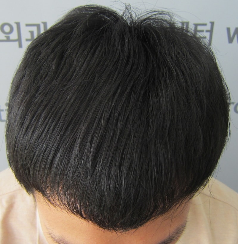 수술후1.JPG