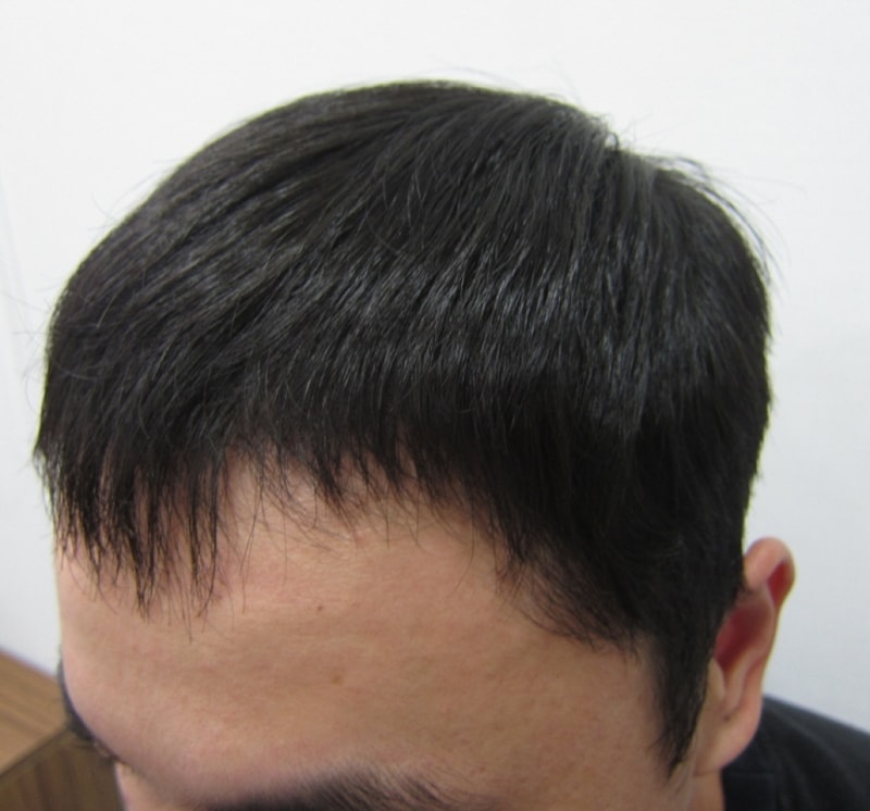 수술후4.JPG