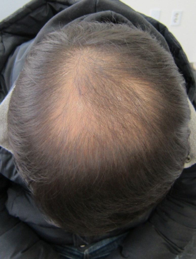 2500 hair follicles 1 year later