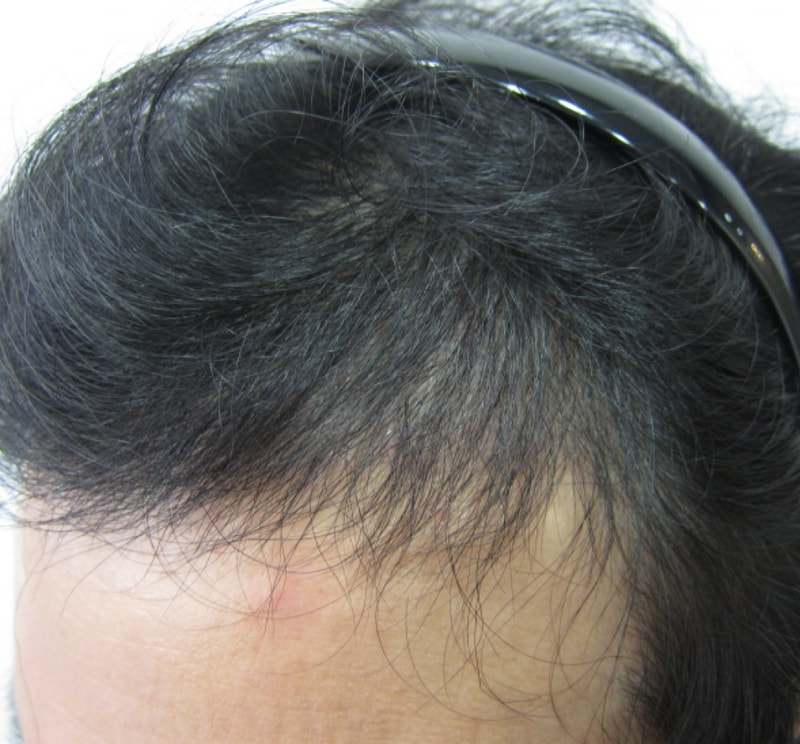 수술후3.JPG