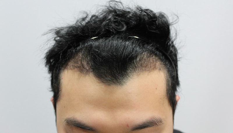 수술후 3개월 3.JPG